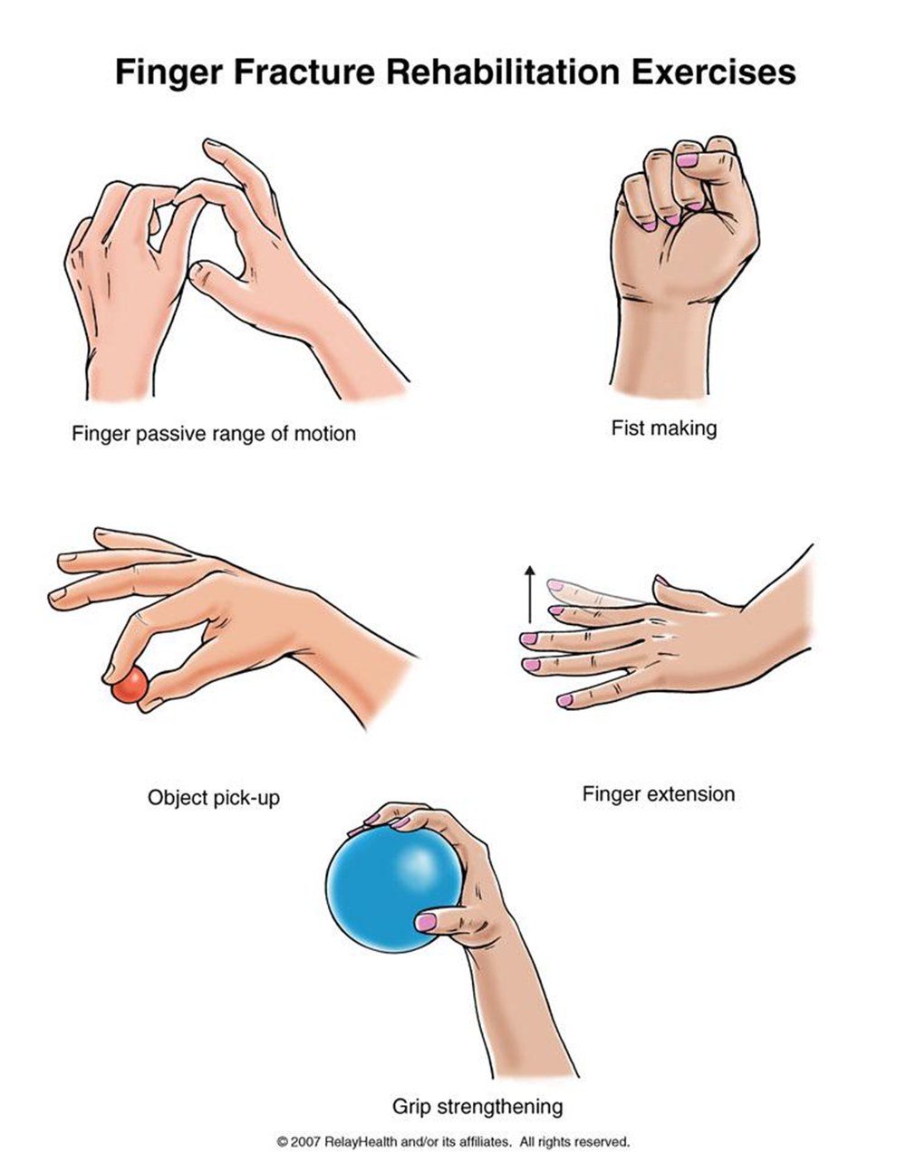 Finger Fracture rehabilitation exercises illustration