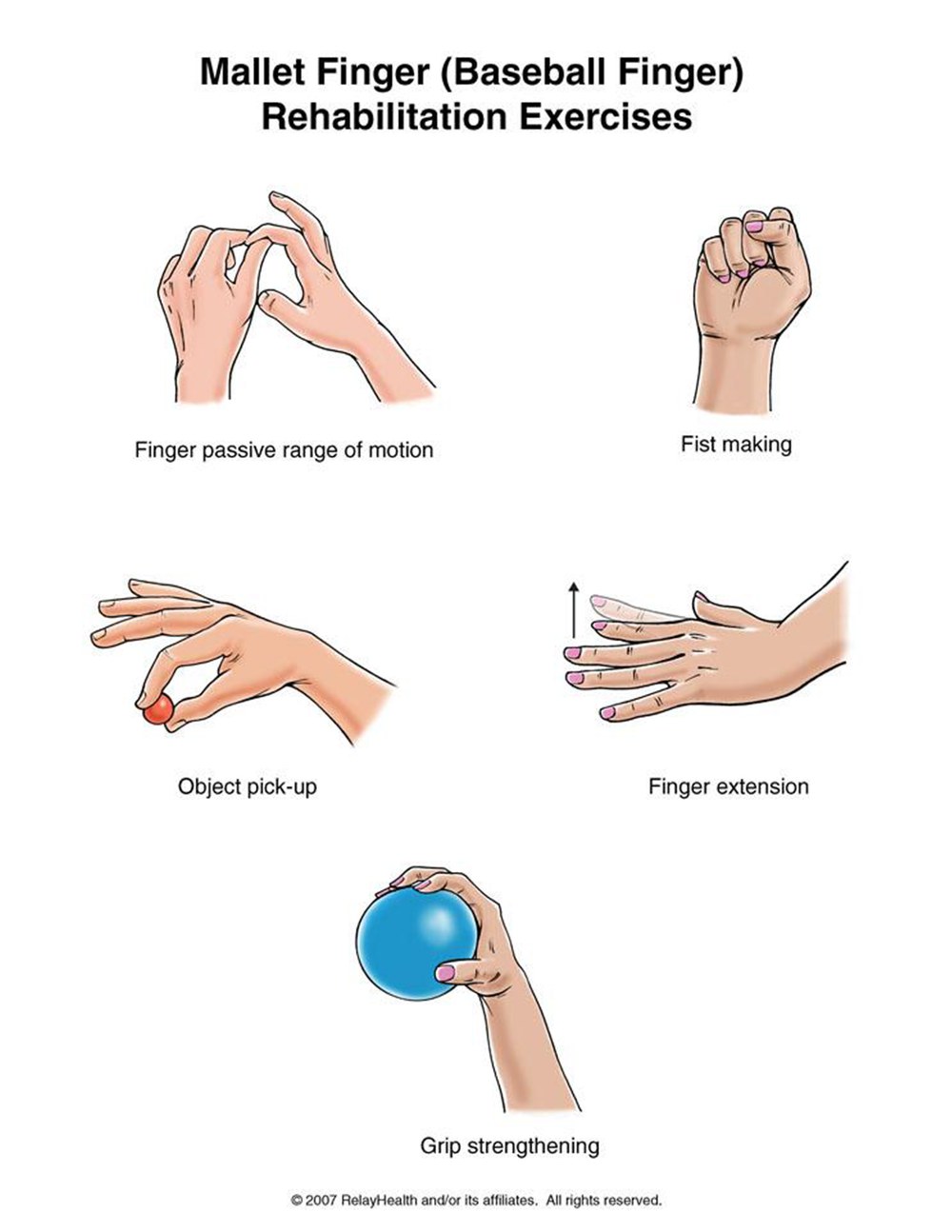 Mallet Finger Rehab rehabilitation exercises illustration